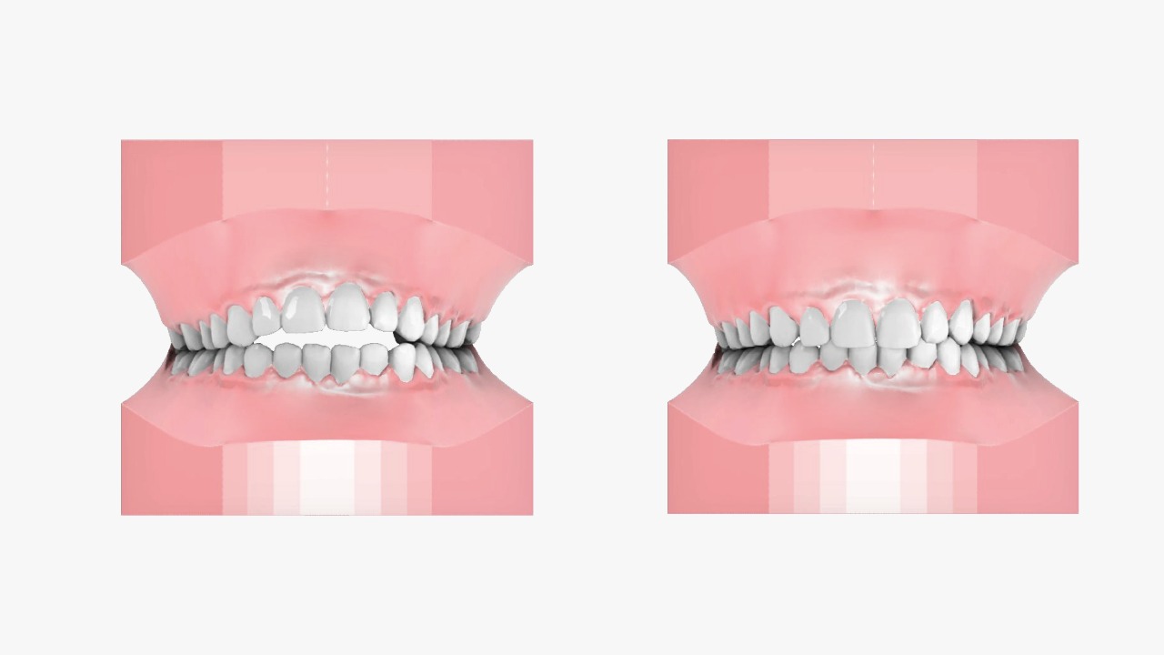 Open Teeth